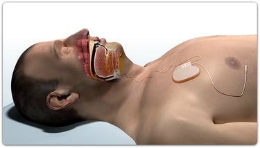 inspire-upper-airway-stimulation-diagram