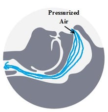 cpap-treatment-diagram