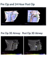 jaw-surgery-surgical-sleep-solutions