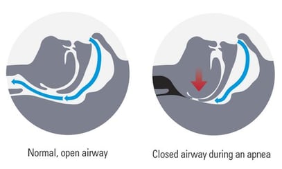what-happens-during-sleep-apnea_diagram