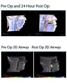 jaw-surgery-surgical-sleep-solutions