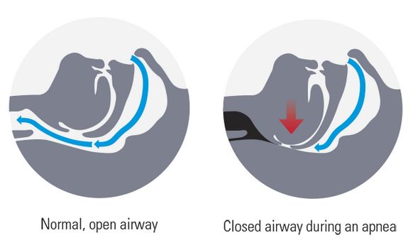 What an apnea looks like